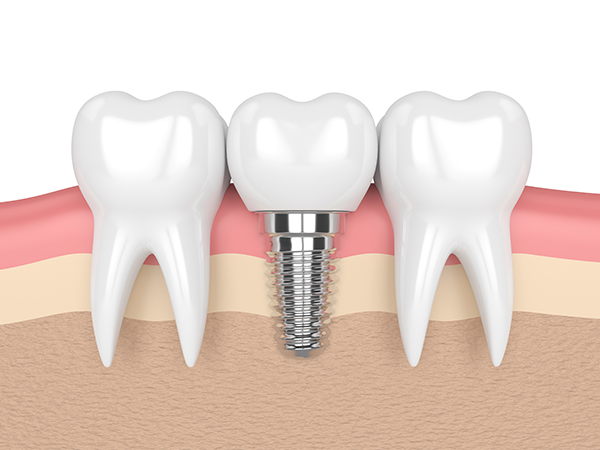 שתלים בשיניים ביום אחד